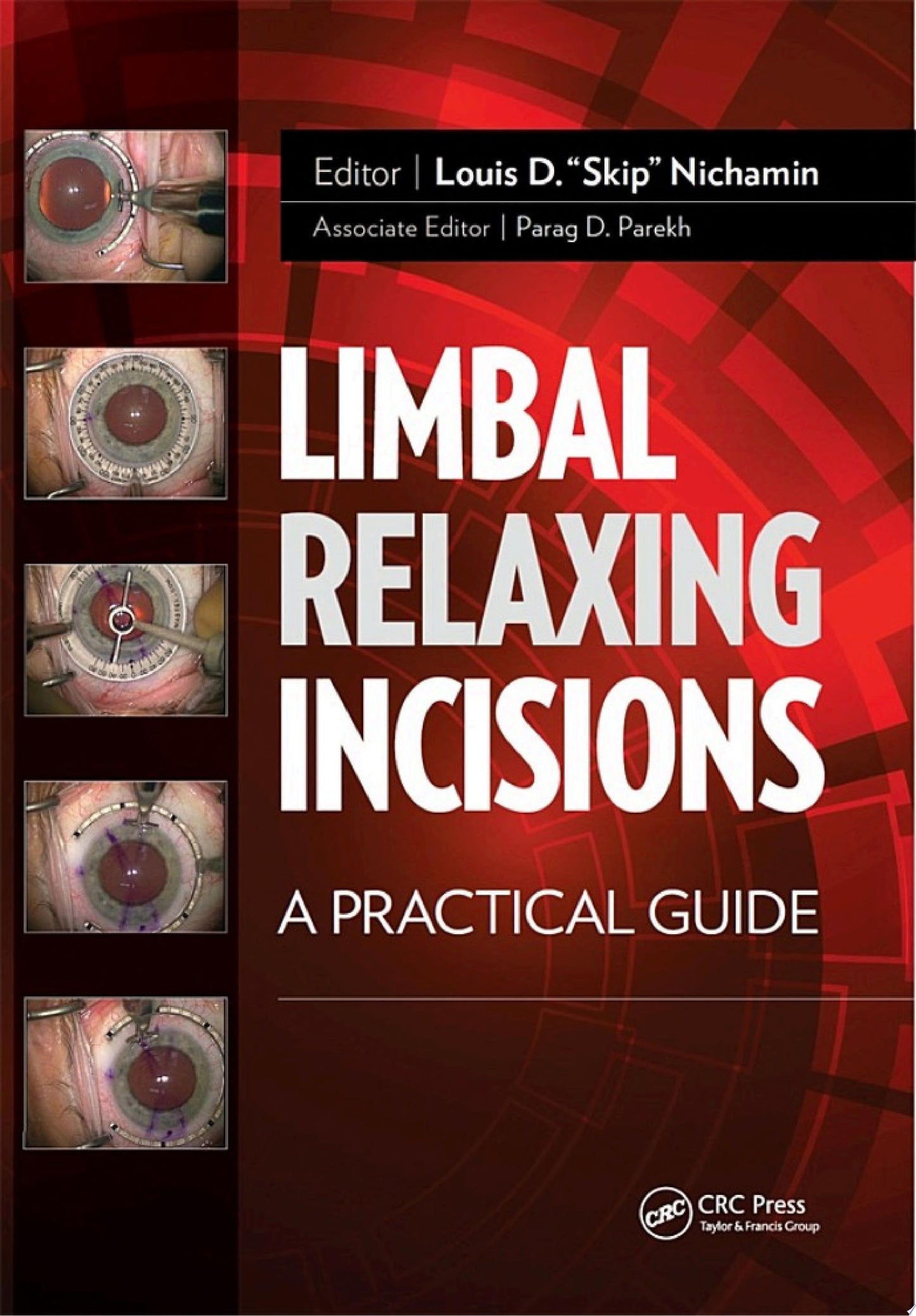 Limbal Relaxing Incisions: A Practical Guide