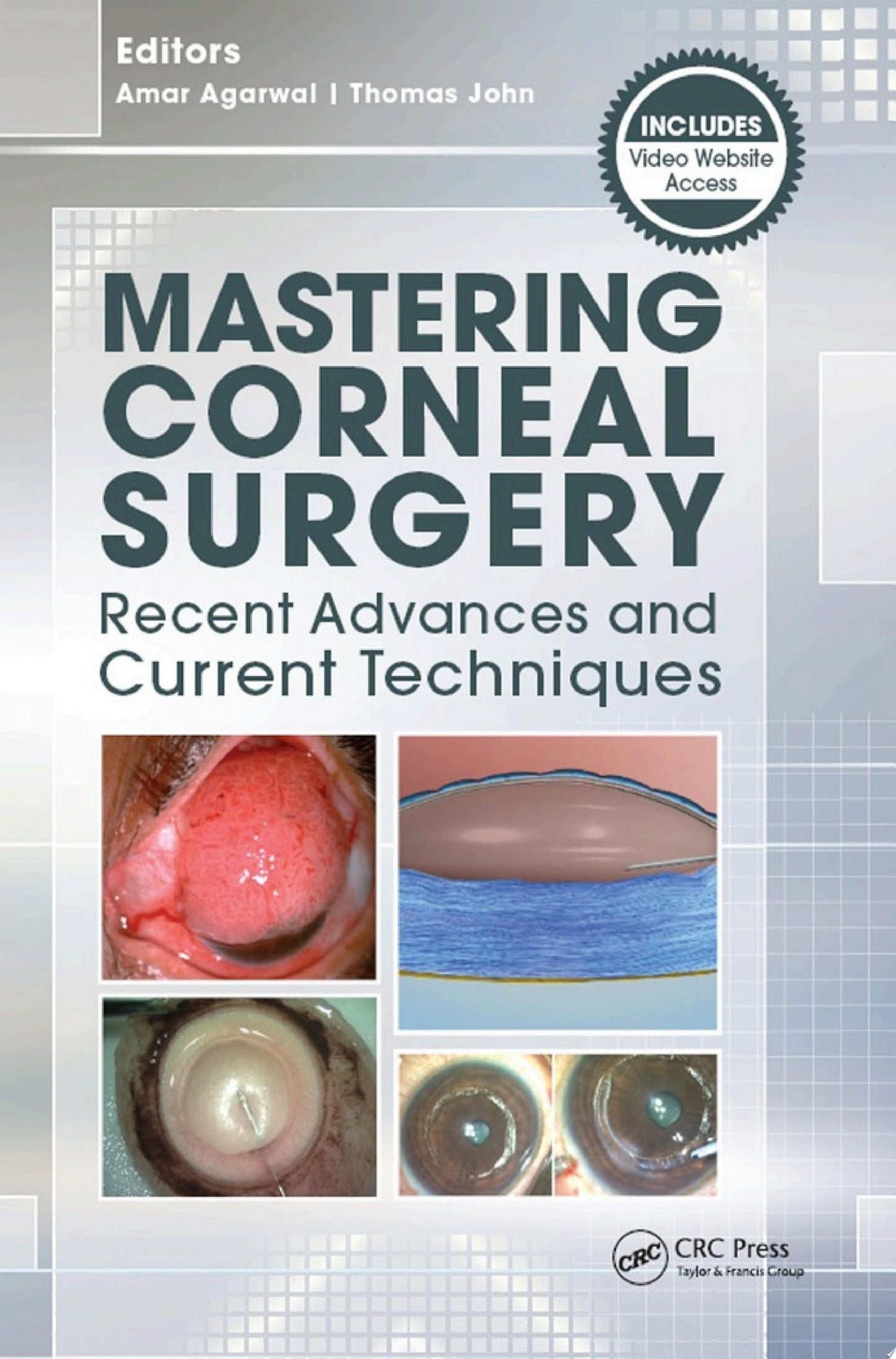 Mastering Corneal Surgery: Recent Advances and Current Techniques