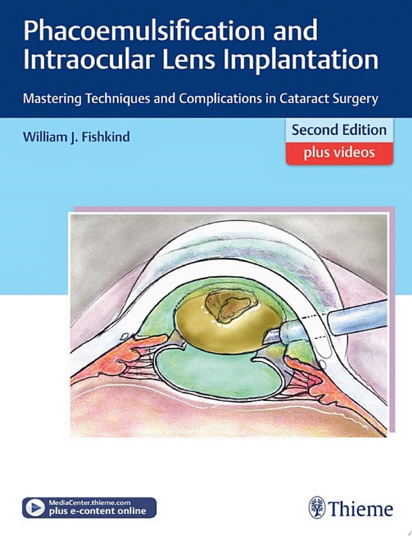 Phacoemulsification and Intraocular Lens Implantation: Mastering Techniques and Complications in Cataract Surgery, 2nd Edition