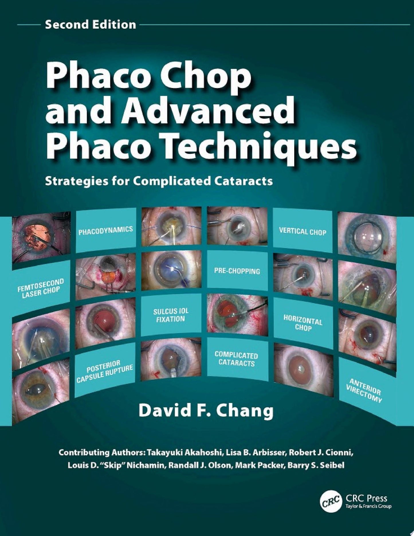 Phaco Chop and Advanced Phaco Techniques: Strategies for Complicated Cataracts