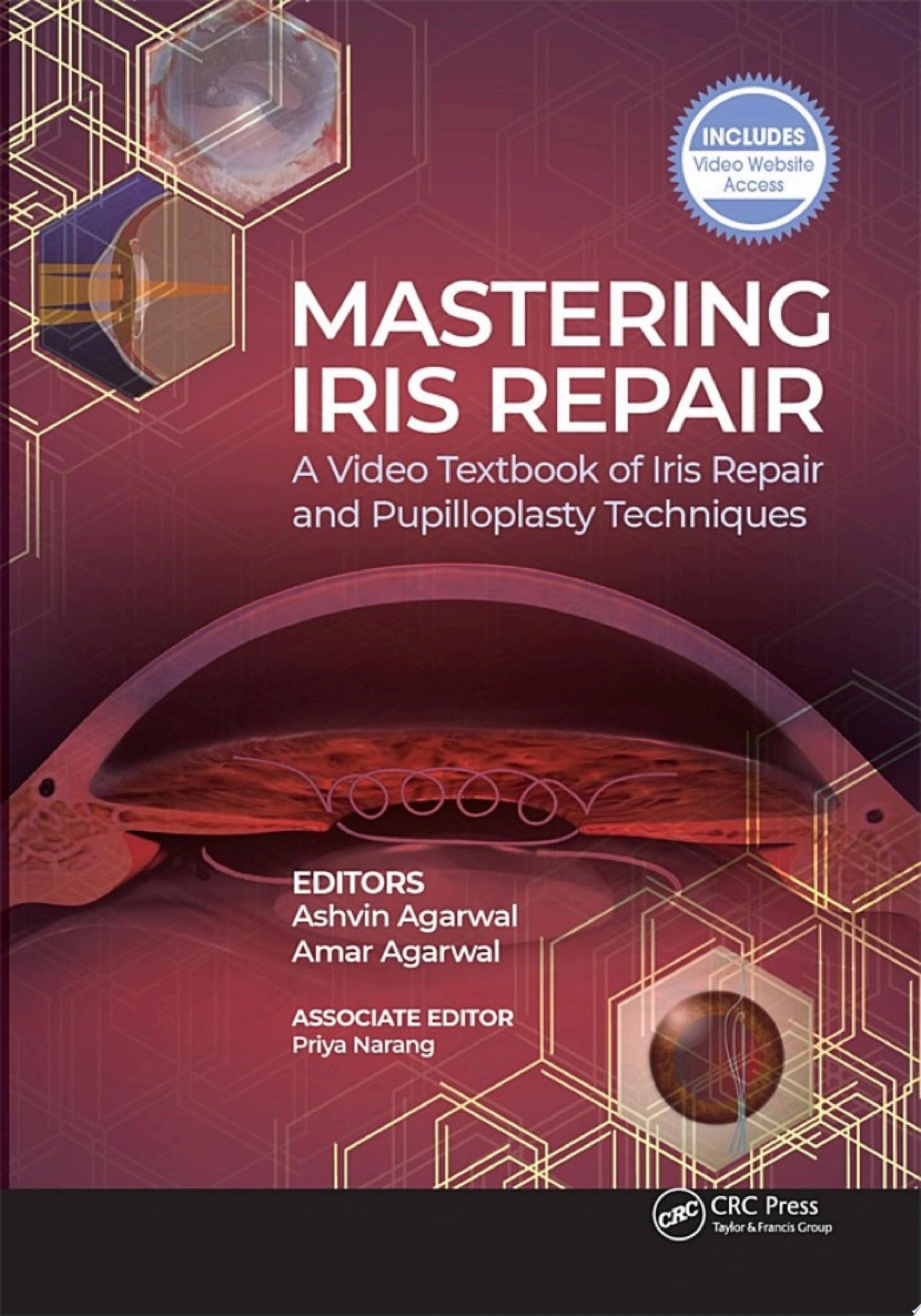 Mastering Iris Repair: A Video Textbook of Iris Repair and Pupilloplasty Techniques