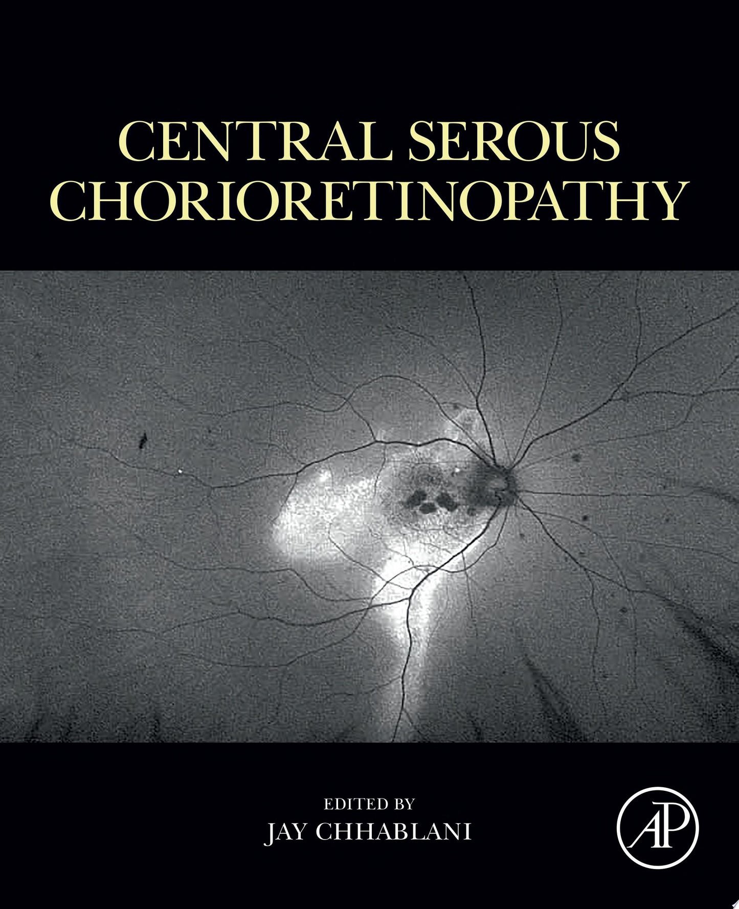Central Serous Chorioretinopathy