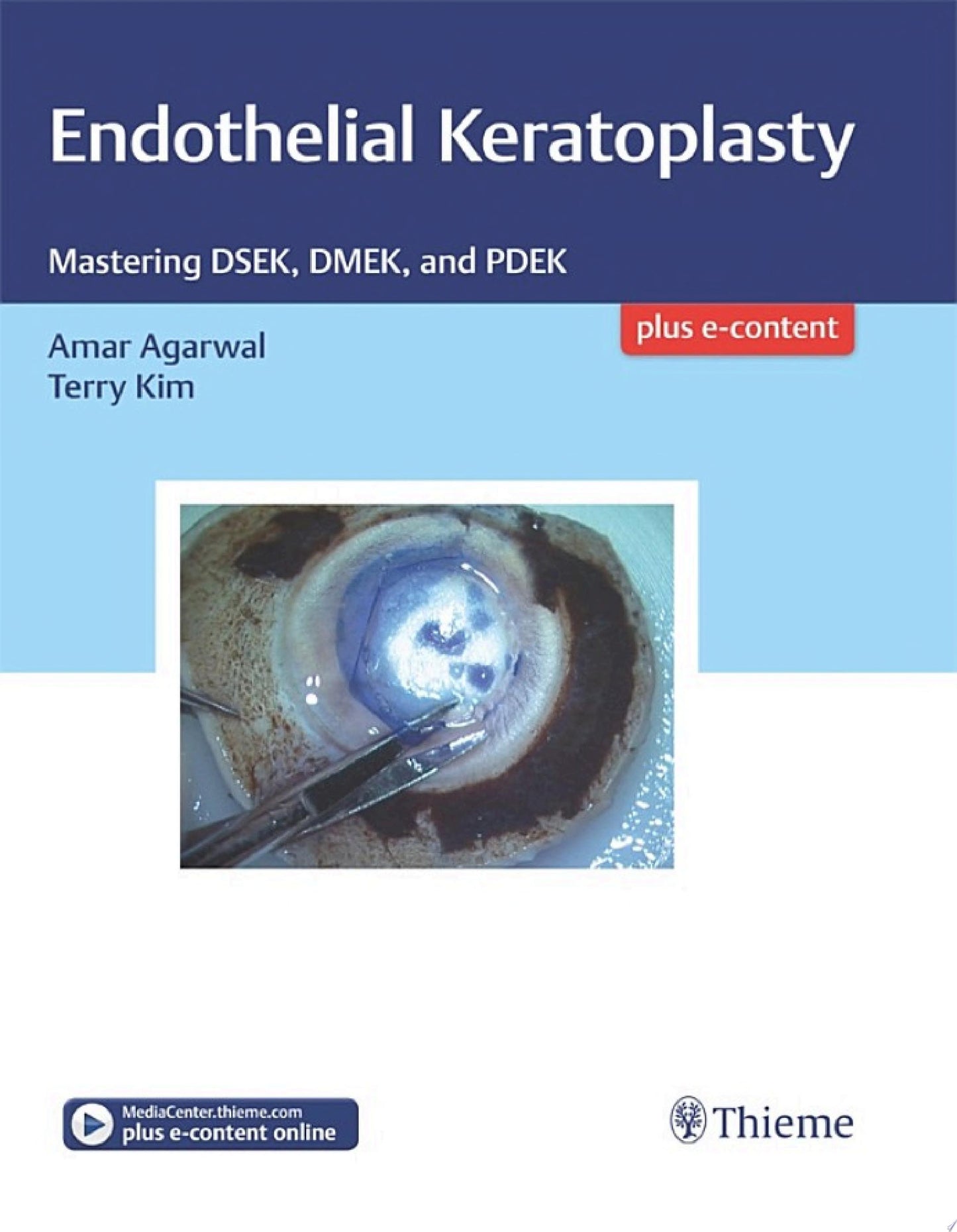 Endothelial Keratoplasty: Mastering DSEK, DMEK, and PDEK