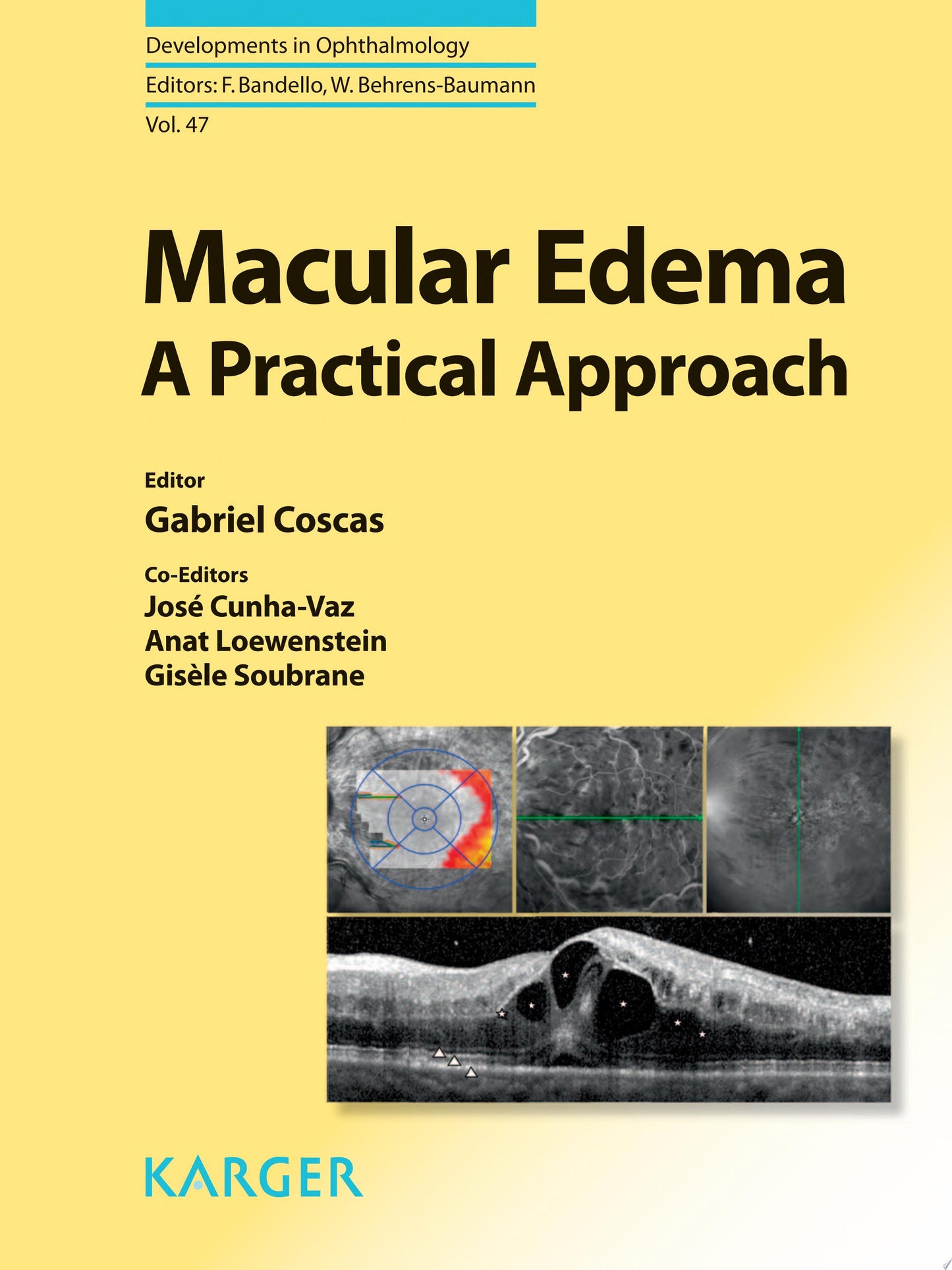 Macular Edema