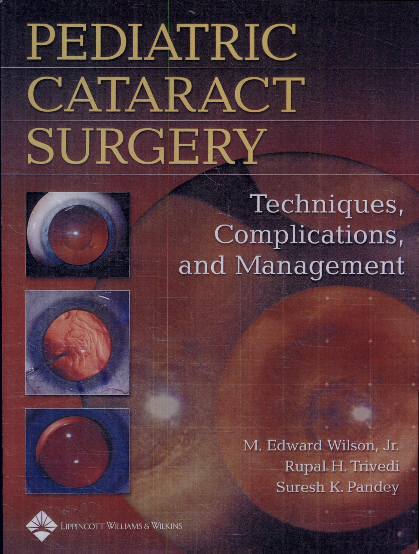 Pediatric Cataract Surgery: Techniques, Complications and Management
