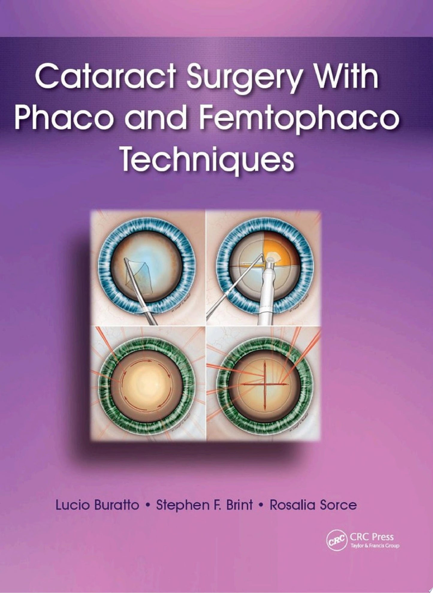 Cataract Surgery with Phaco and Femtophaco Techniques