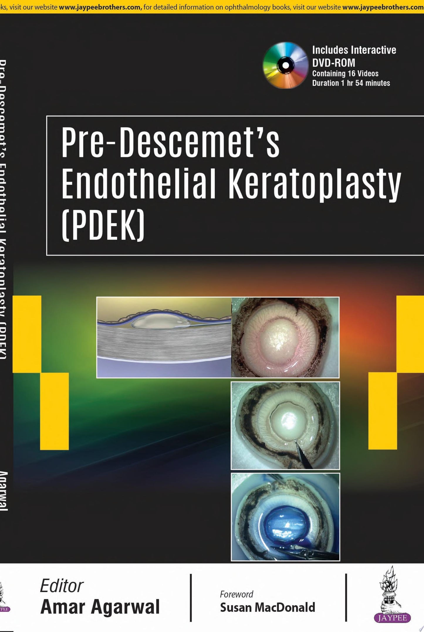 Pre-Descemet’s Endothelial Keratoplasty